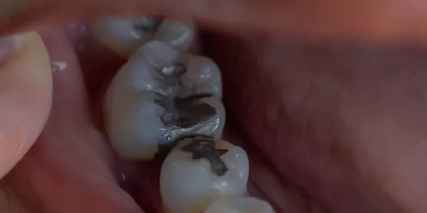 Dental filling in a dark, low-contrast setting.