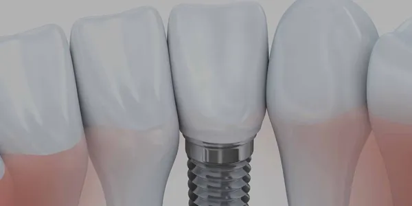 Dental implant in a bright, low-contrast setting.