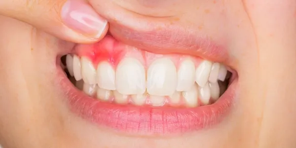 Periodontal treatment in a dark, low-contrast setting.